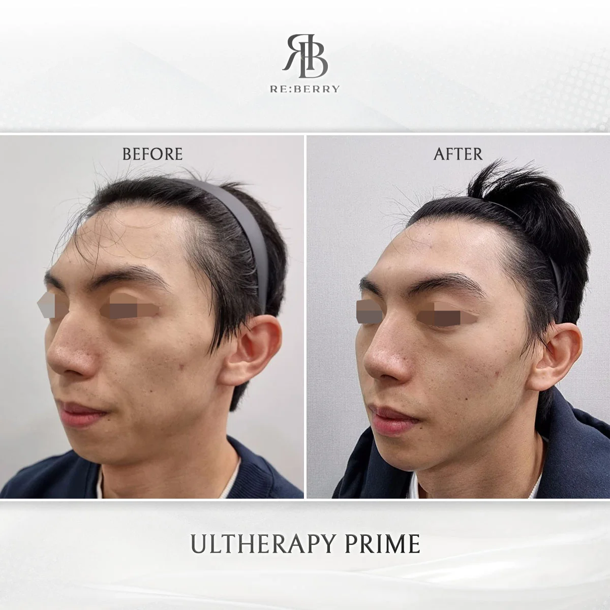 Upper face lifting before and after with Botox and Ultherapy